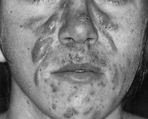 Fig.1 : cystic acne or acne conglobata, picture from Friedrich Bahmer, 2025