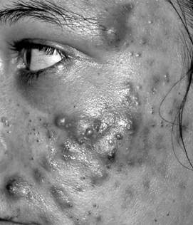 Fig.2 : cystic acne or acne conglobata, picture from Friedrich Bahmer, 2025